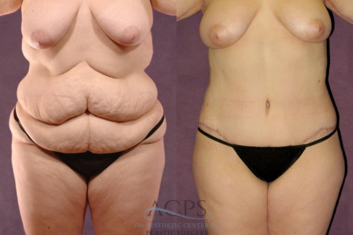 Before & After Body Lift Case 104 Front View: View in Houston, TX