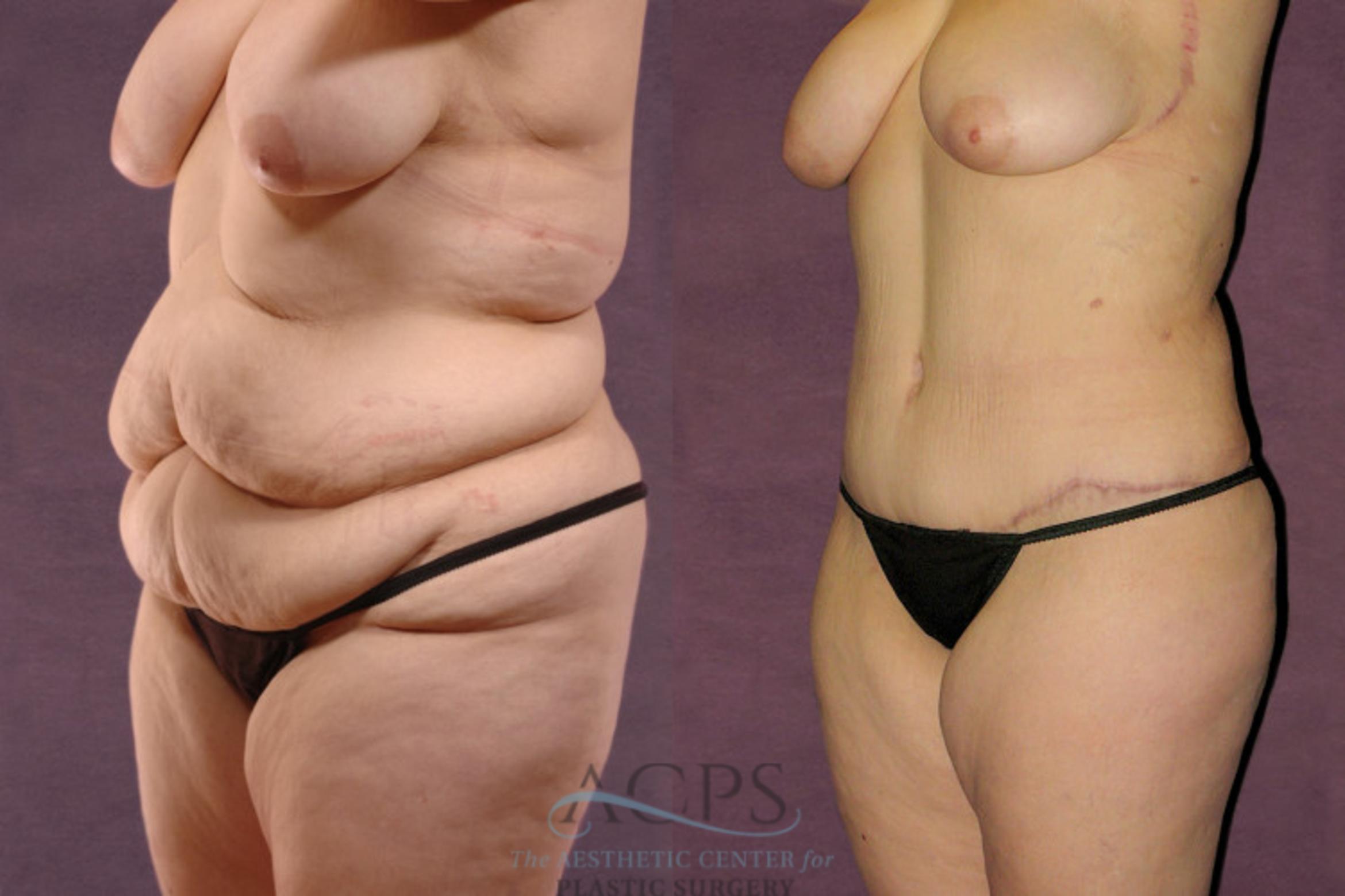 Before & After Body Lift Case 104 Oblique Left View: View in Houston, TX