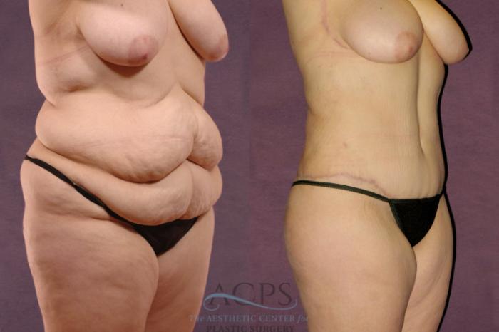 Before & After Body Lift Case 104 Oblique Right View: View in Houston, TX