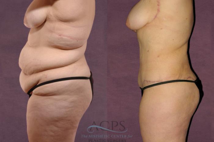 Before & After Body Lift Case 104 Side Left View: View in Houston, TX