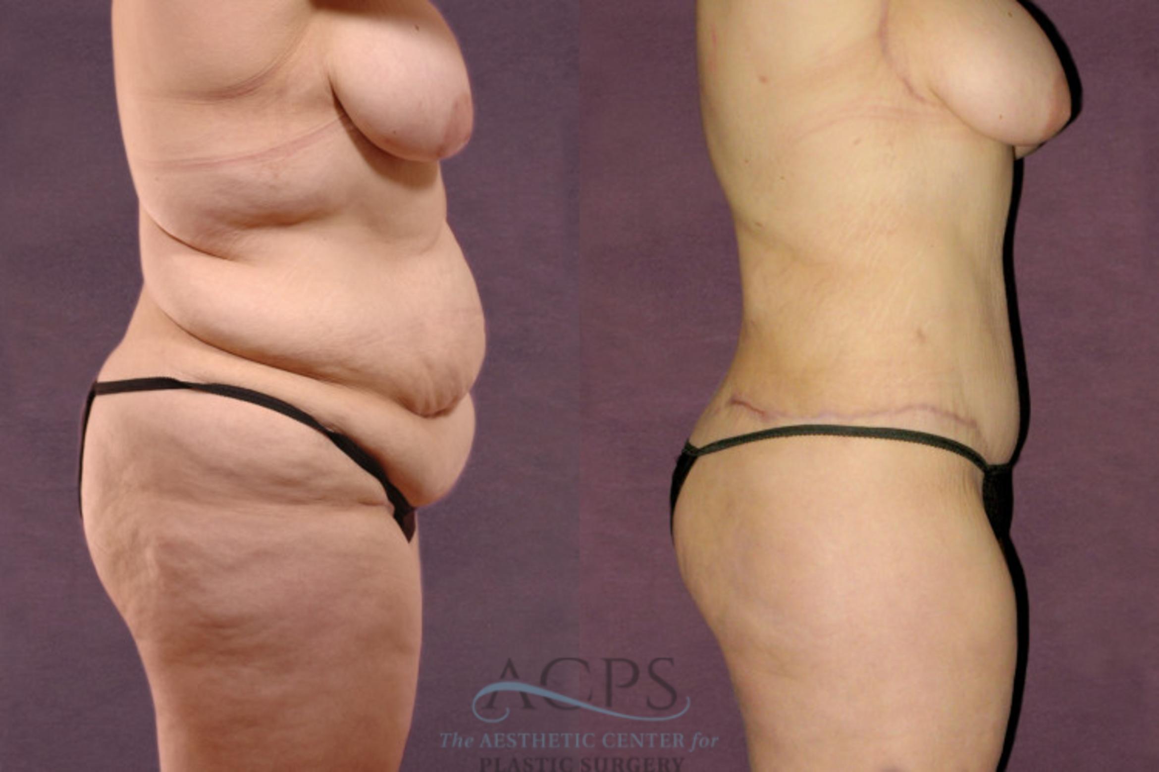 Before & After Body Lift Case 104 Side Right View: View in Houston, TX