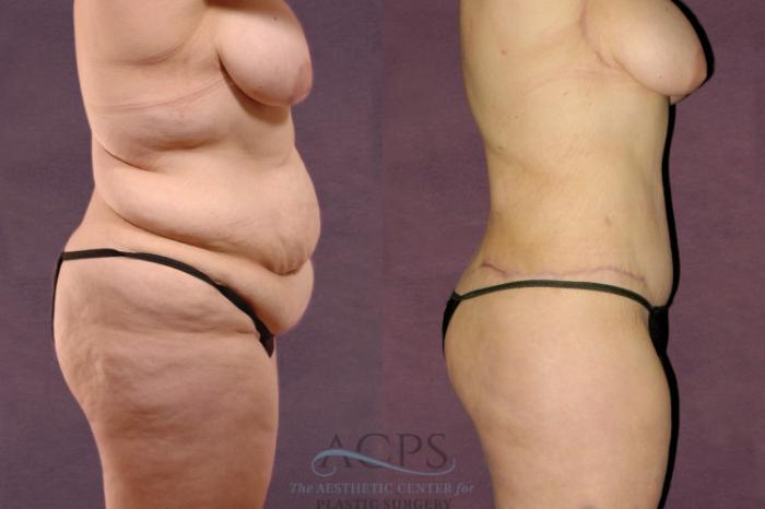 Before & After Body Lift Case 104 Side Right View: View in Houston, TX