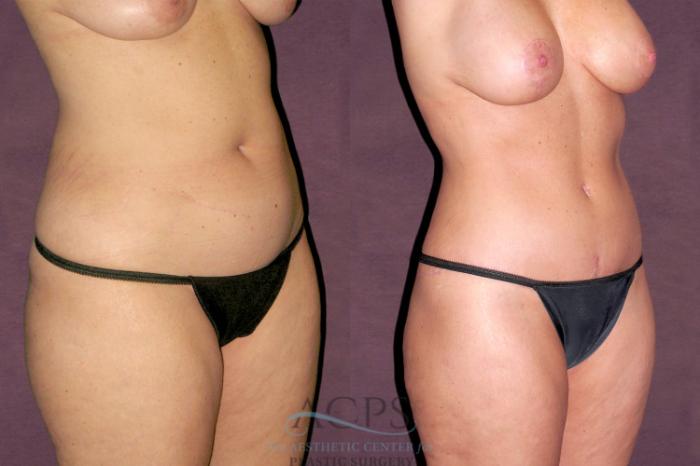 Before & After Tummy Tuck Case 105 Oblique Right View: View in Houston, TX