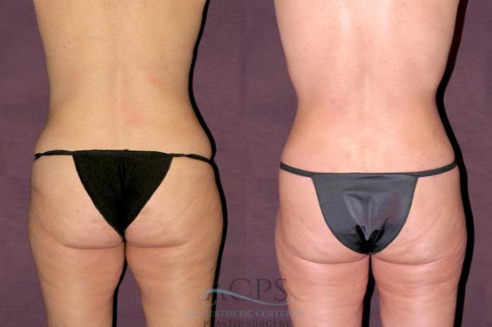 Before & After Tummy Tuck Case 105 Rear View: View in Houston, TX