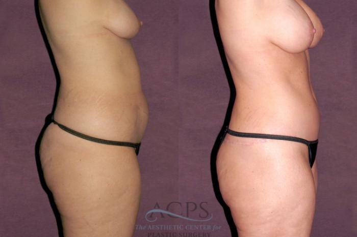 Before & After Tummy Tuck Case 105 Side Right View: View in Houston, TX