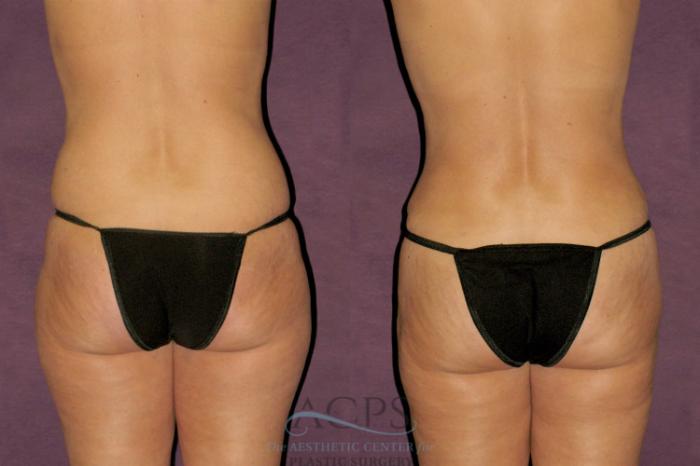 Before & After Tummy Tuck Case 106 Rear View: View in Houston, TX