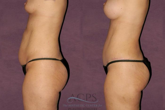 Before & After Tummy Tuck Case 106 Side Left View: View in Houston, TX