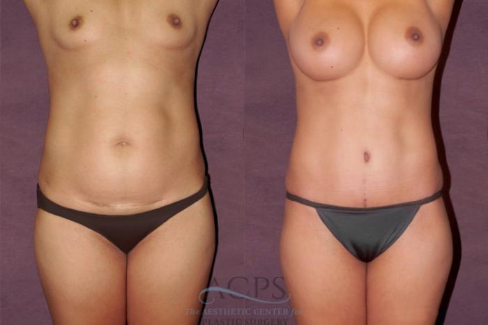 Before & After Tummy Tuck Case 107 Front View: View in Houston, TX