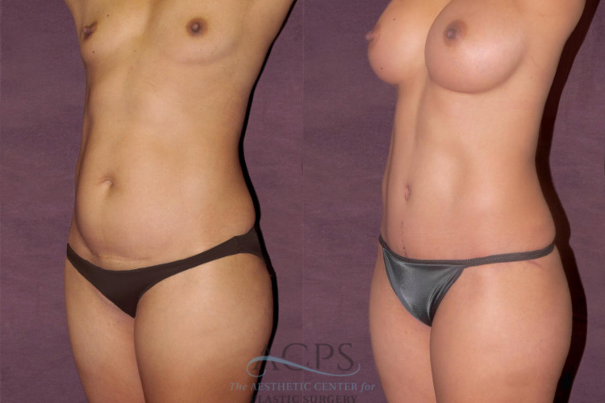 Before & After Tummy Tuck Case 107 Oblique Left View: View in Houston, TX