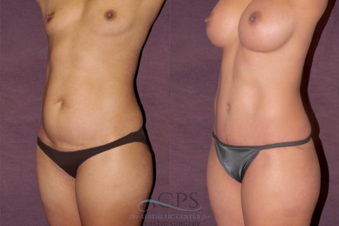Before & After Tummy Tuck Case 107 Oblique Left View: View in Houston, TX