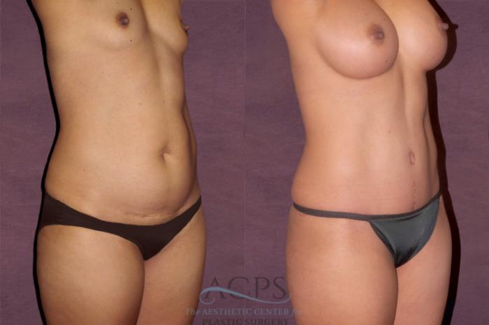 Before & After Tummy Tuck Case 107 Oblique Right View: View in Houston, TX