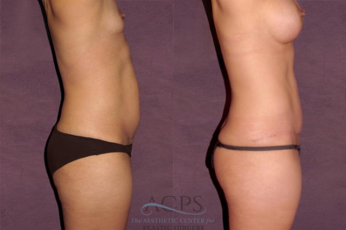 Before & After Tummy Tuck Case 107 Side Right View: View in Houston, TX