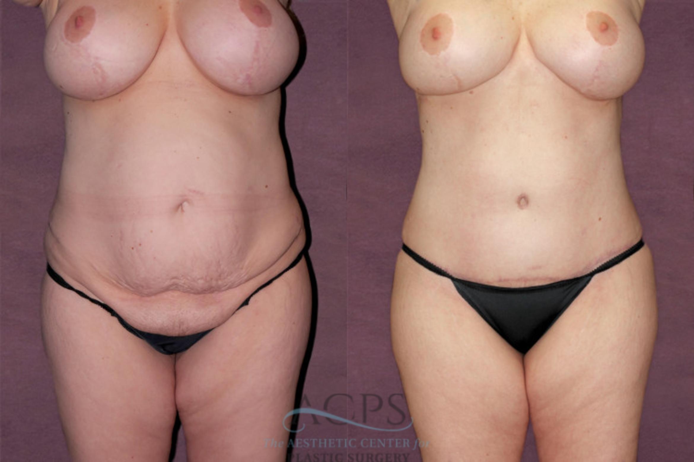Before & After Tummy Tuck Case 108 Front View: View in Houston, TX