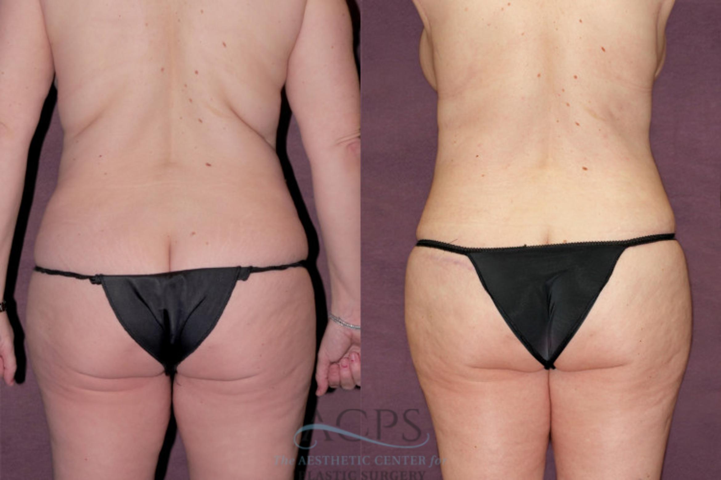 Before & After Tummy Tuck Case 108 Rear View: View in Houston, TX