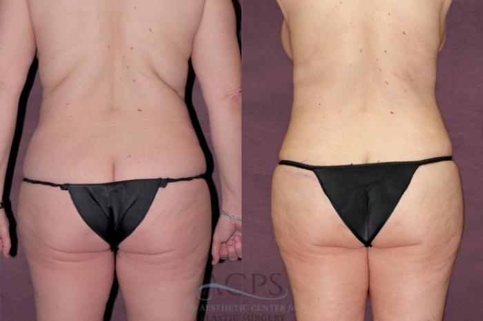 Before & After Tummy Tuck Case 108 Rear View: View in Houston, TX