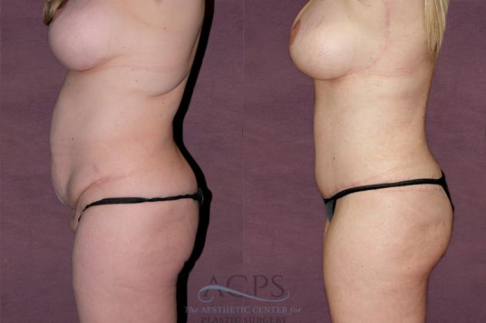 Before & After Tummy Tuck Case 108 Side Left View: View in Houston, TX