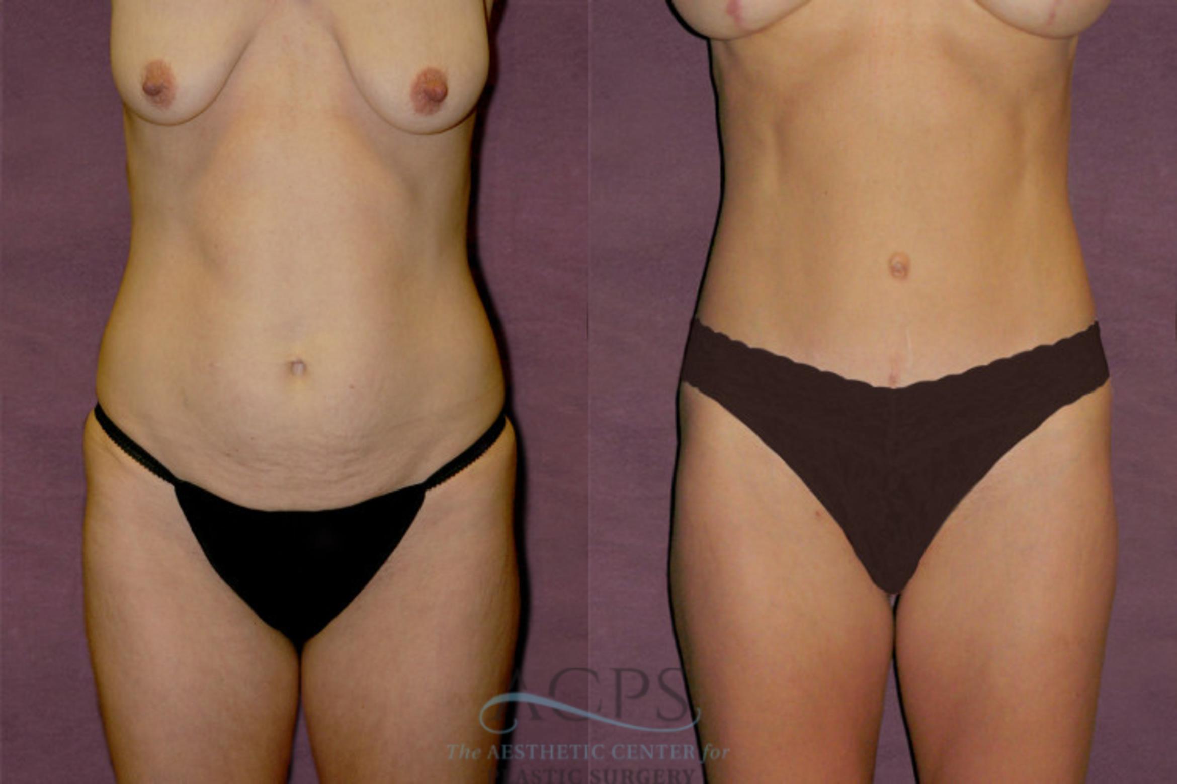 Before & After Tummy Tuck Case 109 Front View: View in Houston, TX