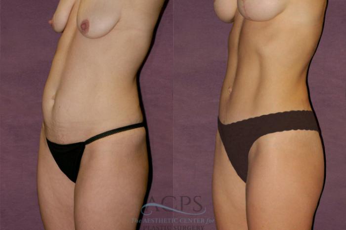 Before & After Tummy Tuck Case 109 Oblique Left View: View in Houston, TX