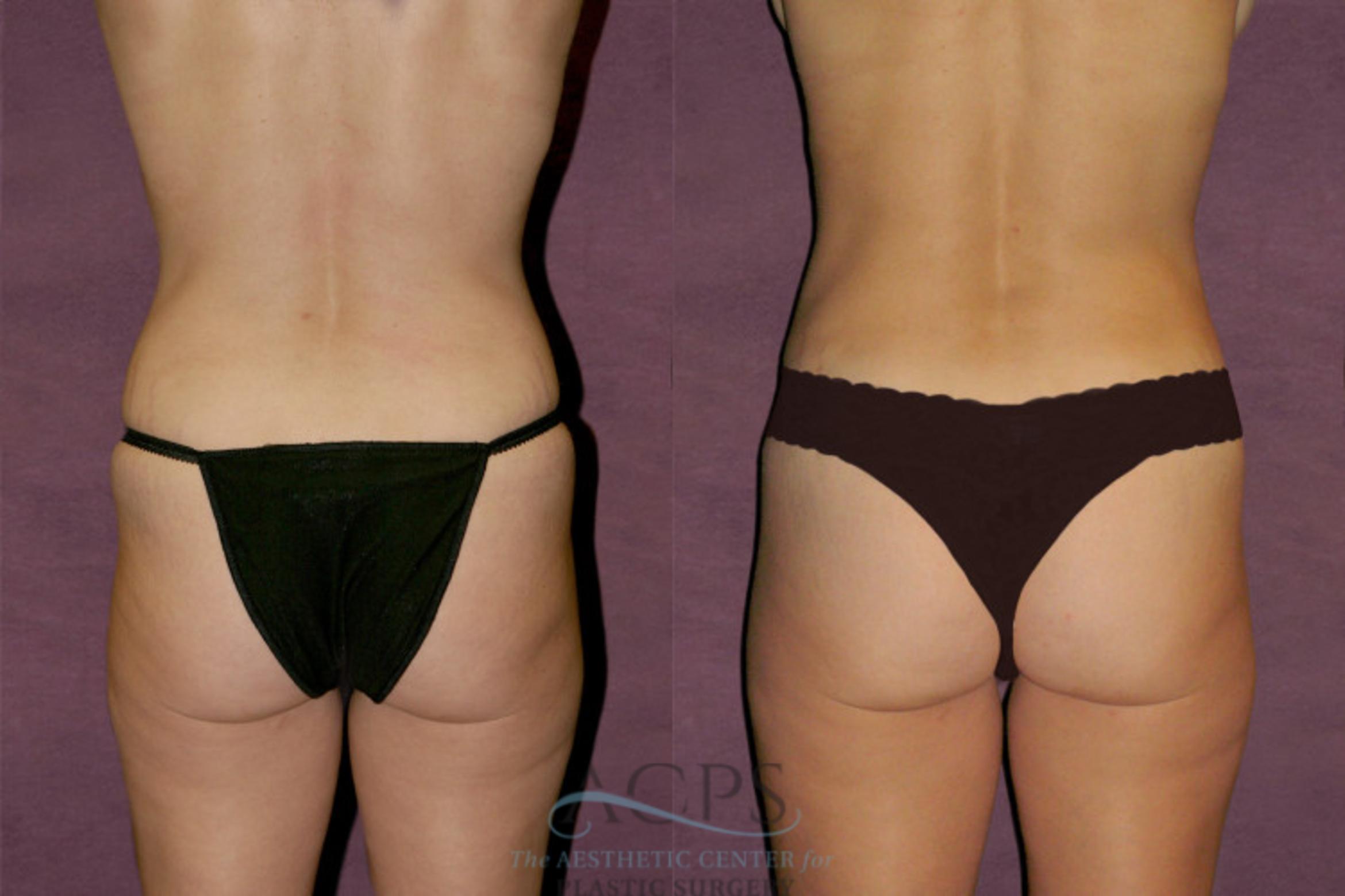 Before & After Tummy Tuck Case 109 Rear View: View in Houston, TX