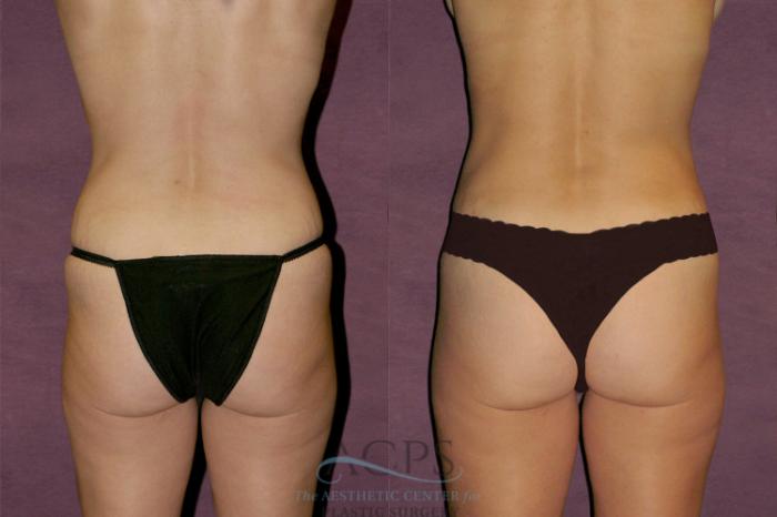 Before & After Tummy Tuck Case 109 Rear View: View in Houston, TX
