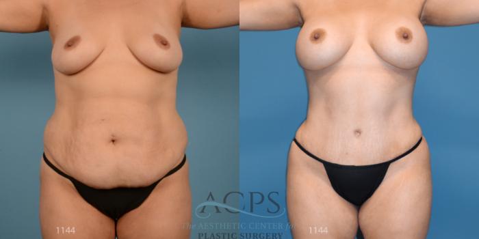 Before & After Tummy Tuck Case 11 Front View: View in Houston, TX