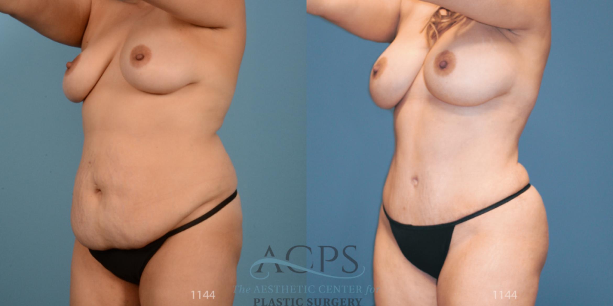 Before & After Tummy Tuck Case 11 Oblique View: View in Houston, TX