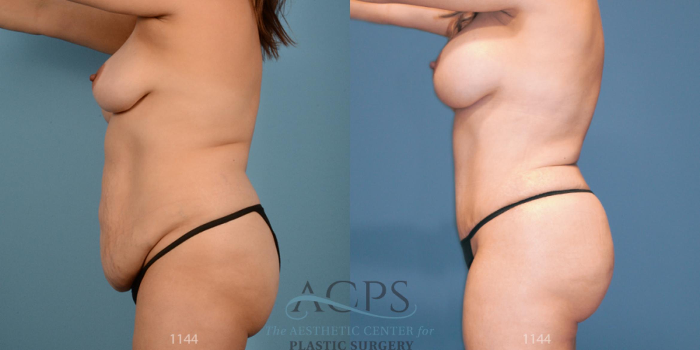 Before & After Tummy Tuck Case 11 Side View: View in Houston, TX