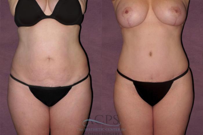 Before & After Tummy Tuck Case 110 Front View: View in Houston, TX