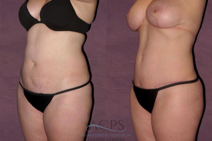 Before & After Tummy Tuck Case 110 Oblique Left View: View in Houston, TX