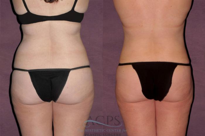 Before & After Tummy Tuck Case 110 Rear View: View in Houston, TX