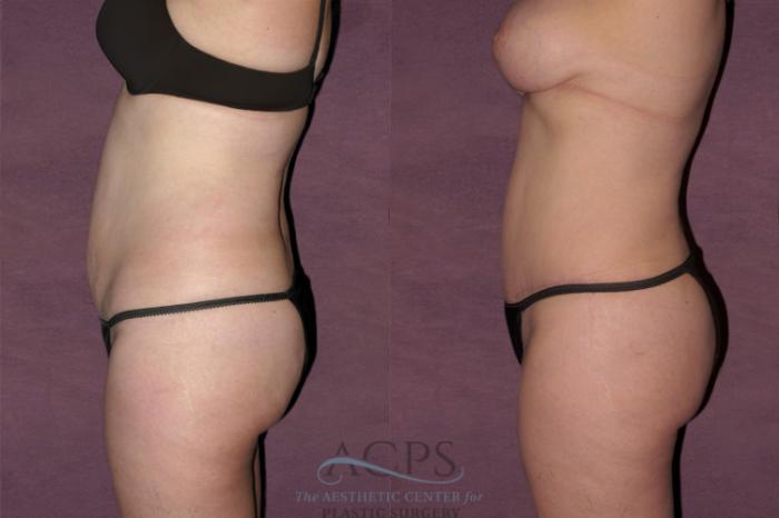 Before & After Tummy Tuck Case 110 Side Left View: View in Houston, TX