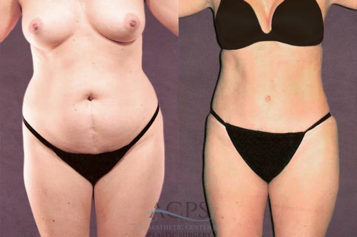Before & After Tummy Tuck Case 111 Front View: View in Houston, TX