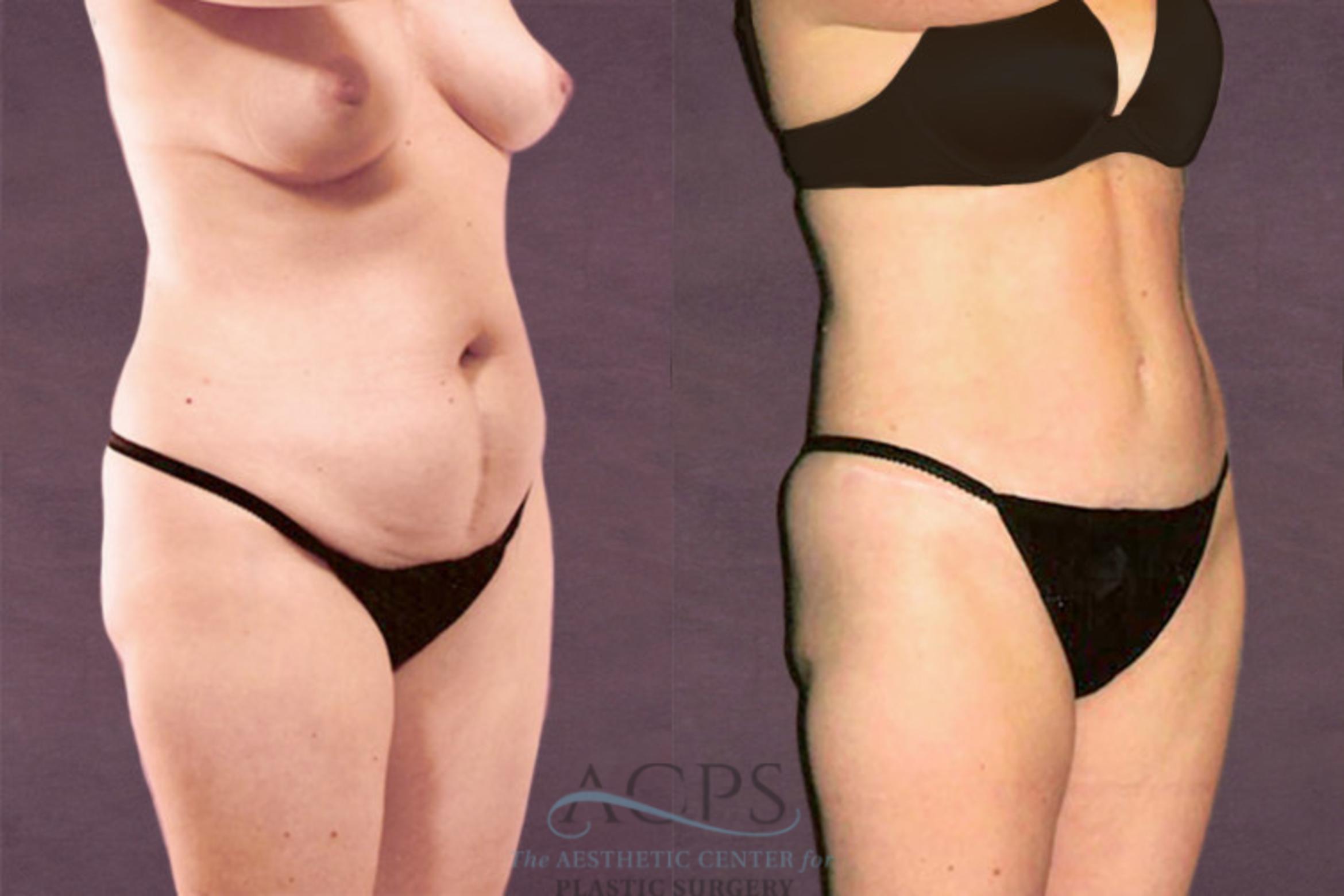 Before & After Tummy Tuck Case 111 Oblique Right View: View in Houston, TX