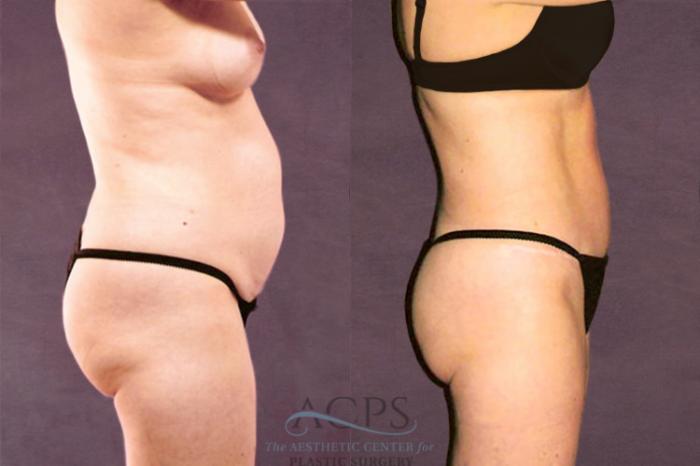 Before & After Tummy Tuck Case 111 Side Right View: View in Houston, TX