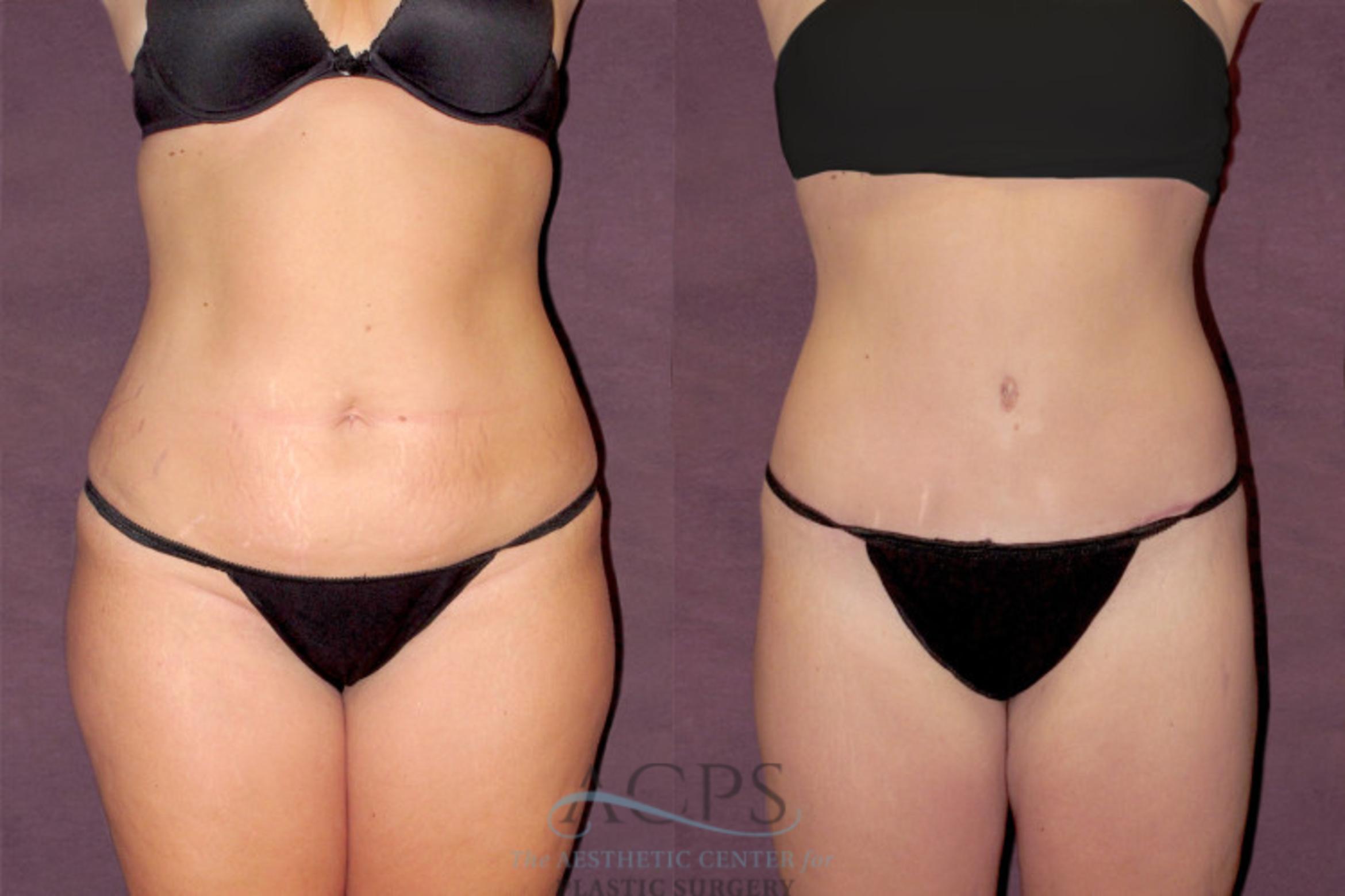 Before & After Tummy Tuck Case 112 Front View: View in Houston, TX