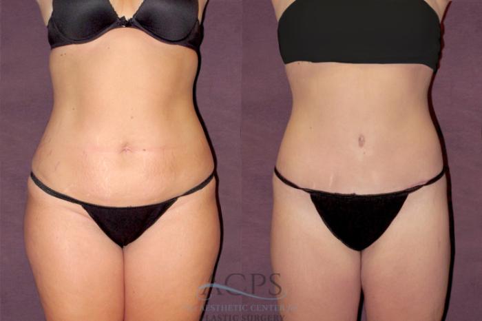 Before & After Tummy Tuck Case 112 Front View: View in Houston, TX