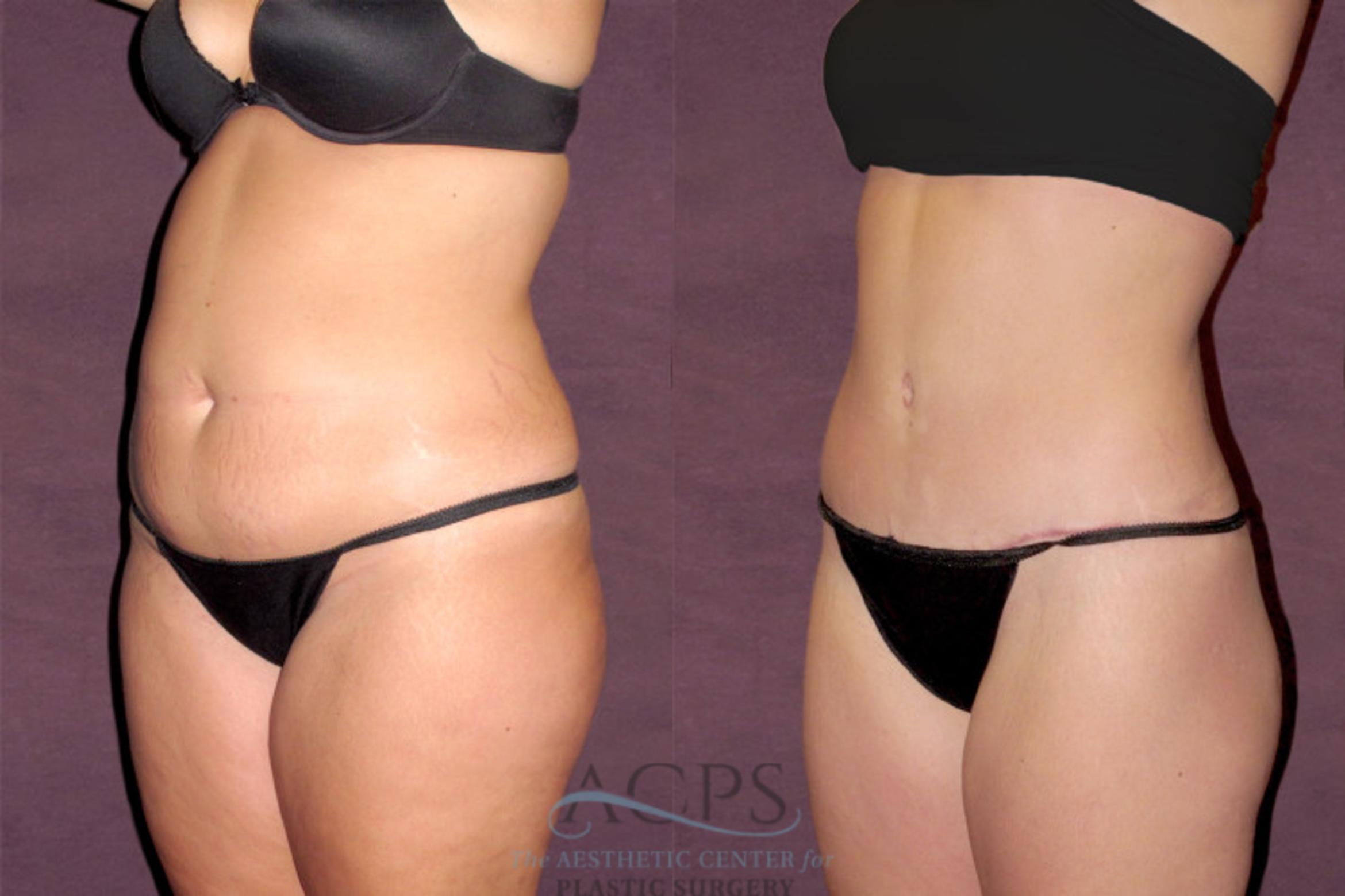 Before & After Tummy Tuck Case 112 Oblique Left View: View in Houston, TX