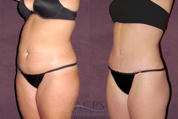 Before & After Tummy Tuck Case 112 Oblique Left View: View in Houston, TX