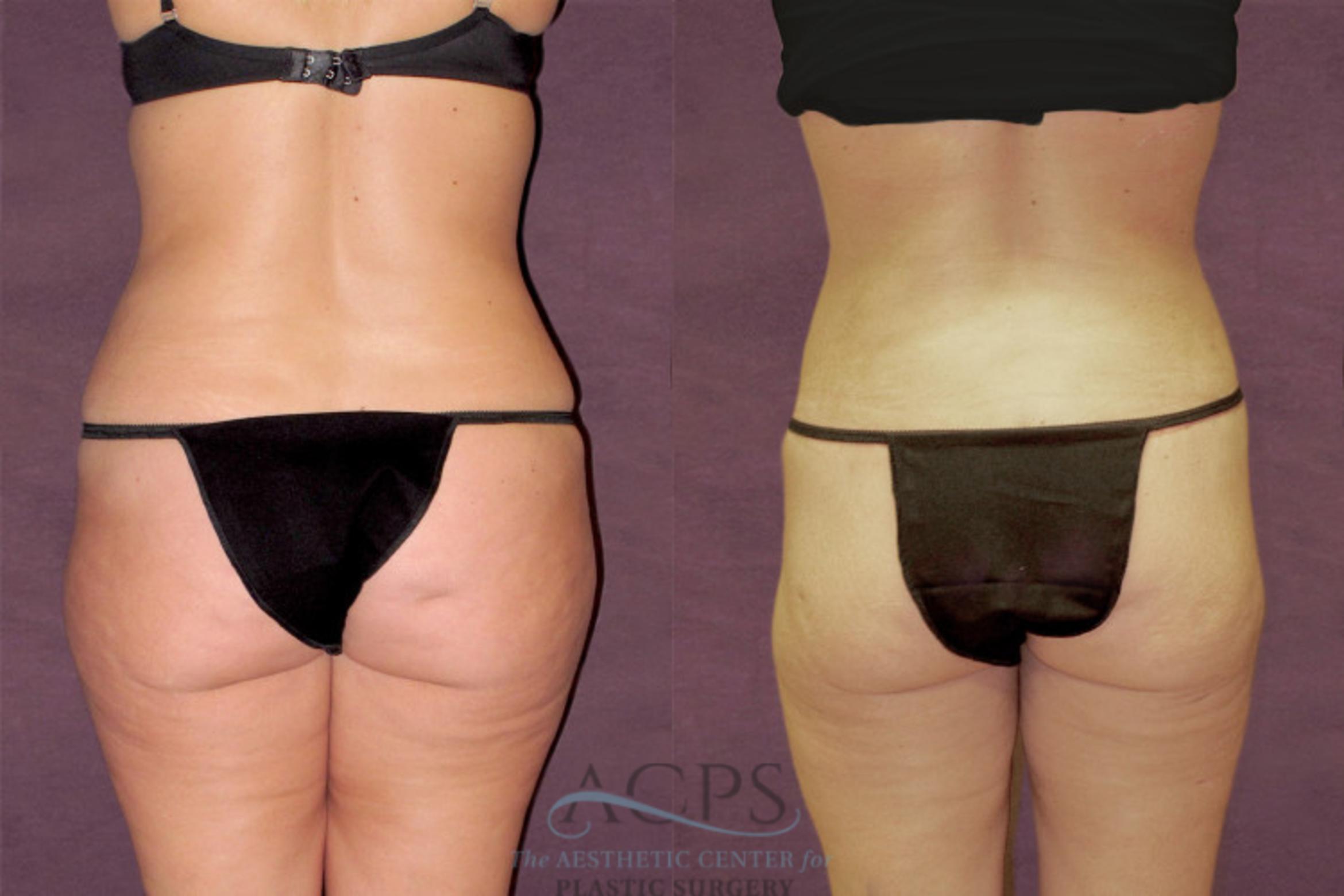 Before & After Tummy Tuck Case 112 Rear View: View in Houston, TX