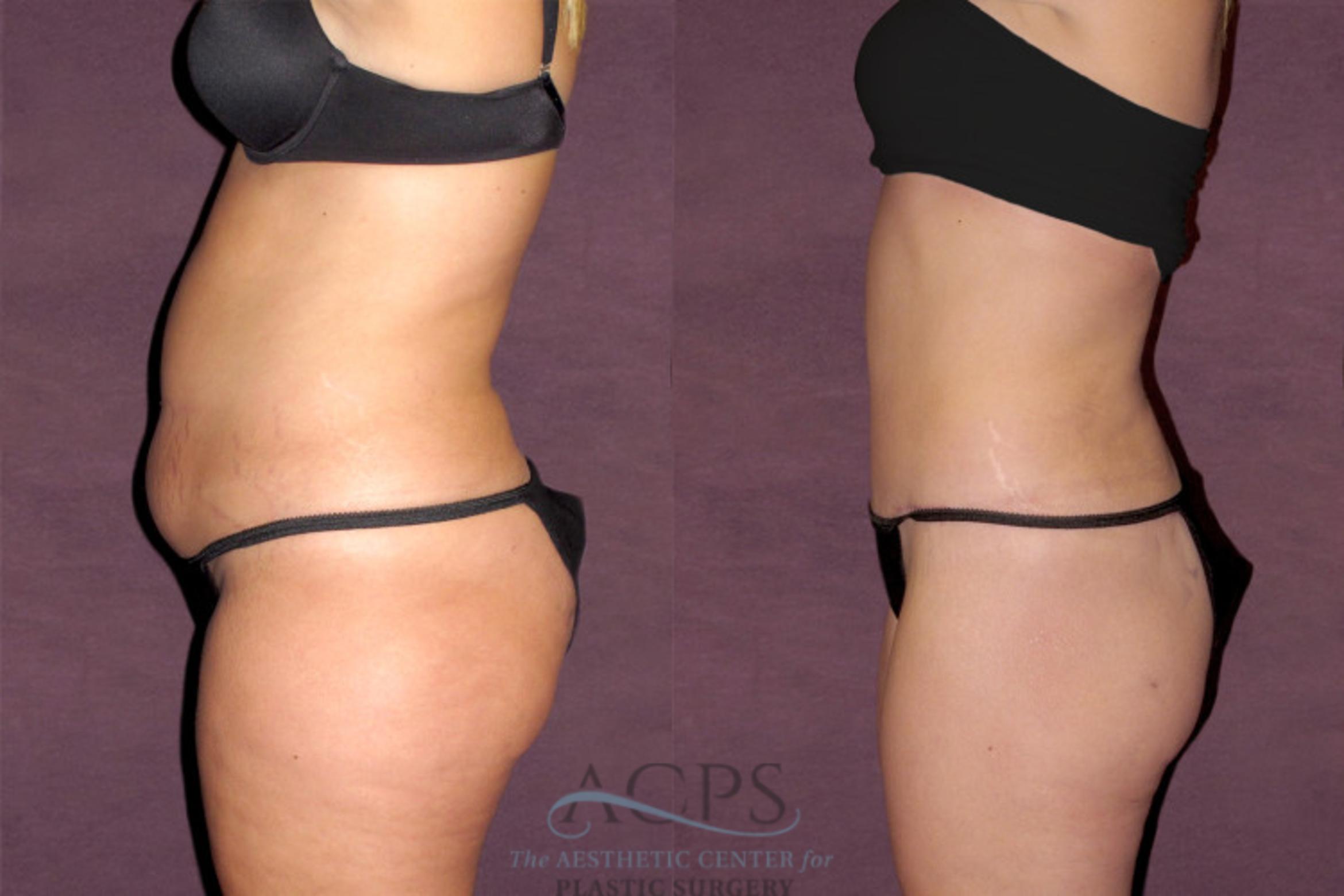 Before & After Tummy Tuck Case 112 Side Left View: View in Houston, TX