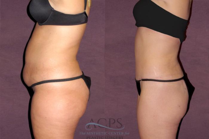 Before & After Tummy Tuck Case 112 Side Left View: View in Houston, TX