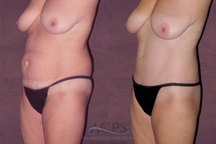 Before & After Tummy Tuck Case 113 Oblique Left View: View in Houston, TX