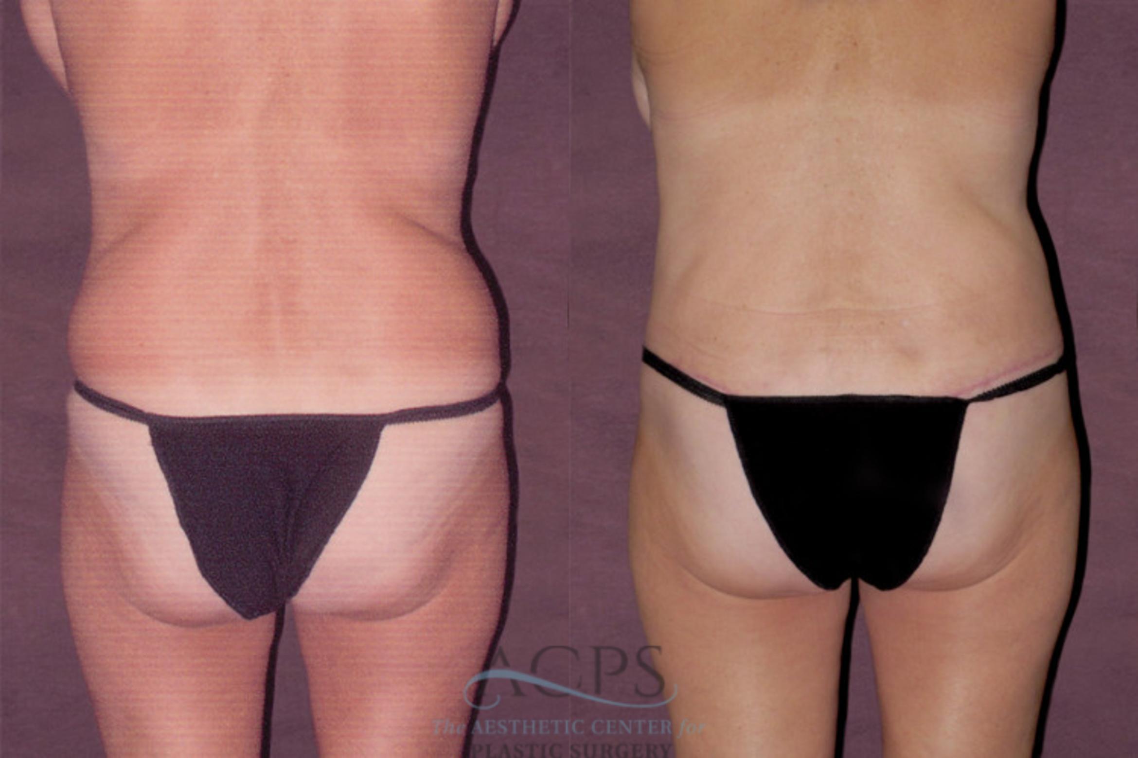 Before & After Tummy Tuck Case 113 Rear View: View in Houston, TX
