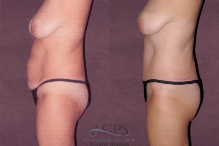 Before & After Tummy Tuck Case 113 Side Left View: View in Houston, TX
