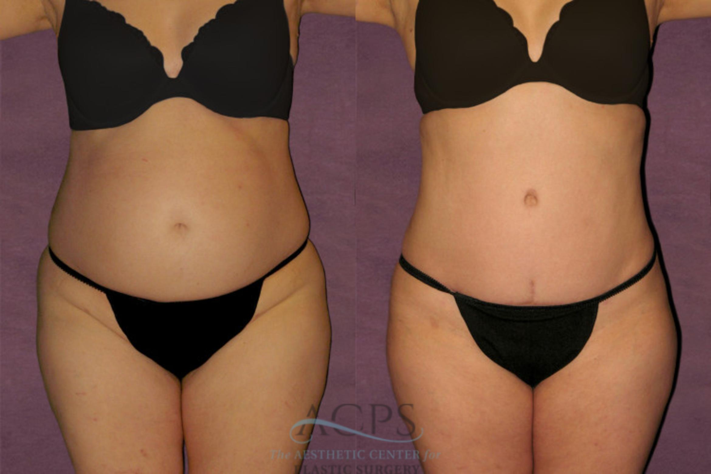 Before & After Tummy Tuck Case 114 Front View: View in Houston, TX