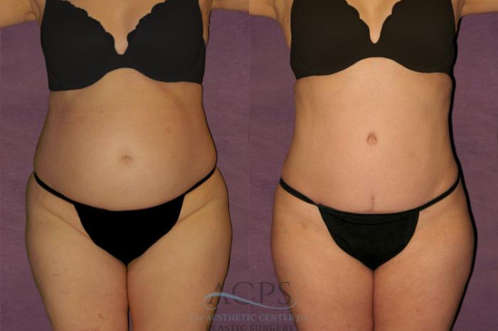 Before & After Tummy Tuck Case 114 Front View: View in Houston, TX