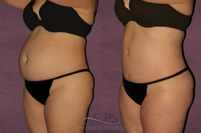 Before & After Tummy Tuck Case 114 Oblique Left View: View in Houston, TX