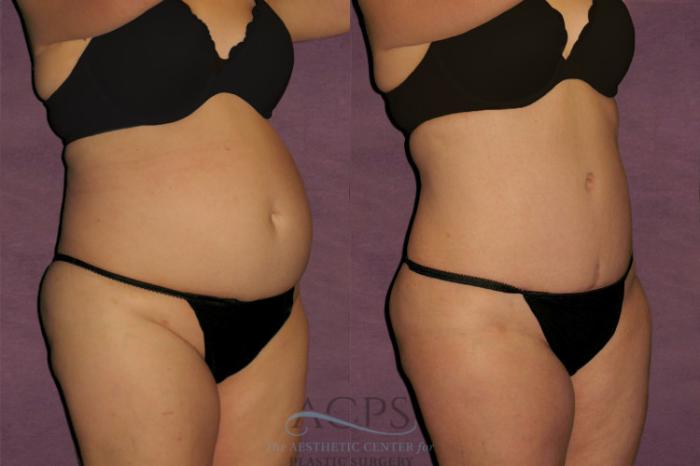 Before & After Tummy Tuck Case 114 Oblique Right View: View in Houston, TX