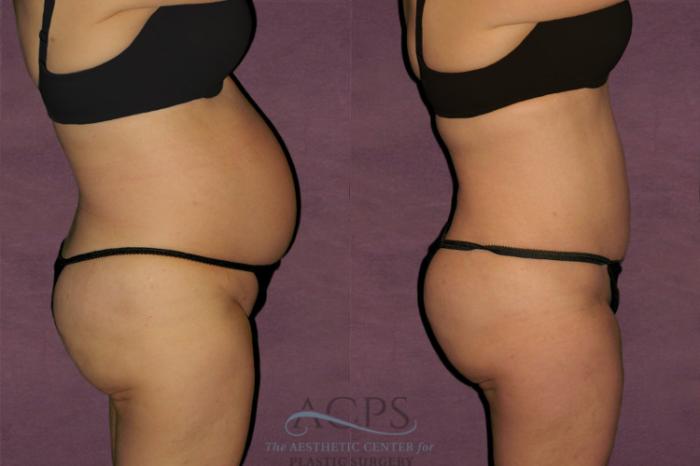Before & After Tummy Tuck Case 114 Side Right View: View in Houston, TX