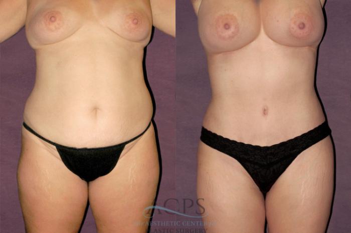 Before & After Liposuction Case 115 Front View: View in Houston, TX